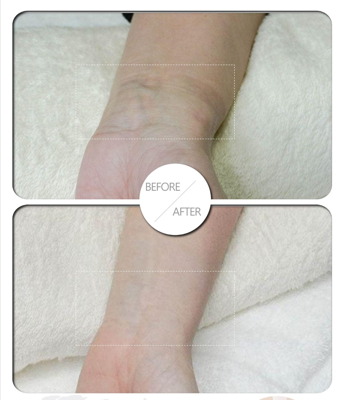 BB Cover Before and After Hand