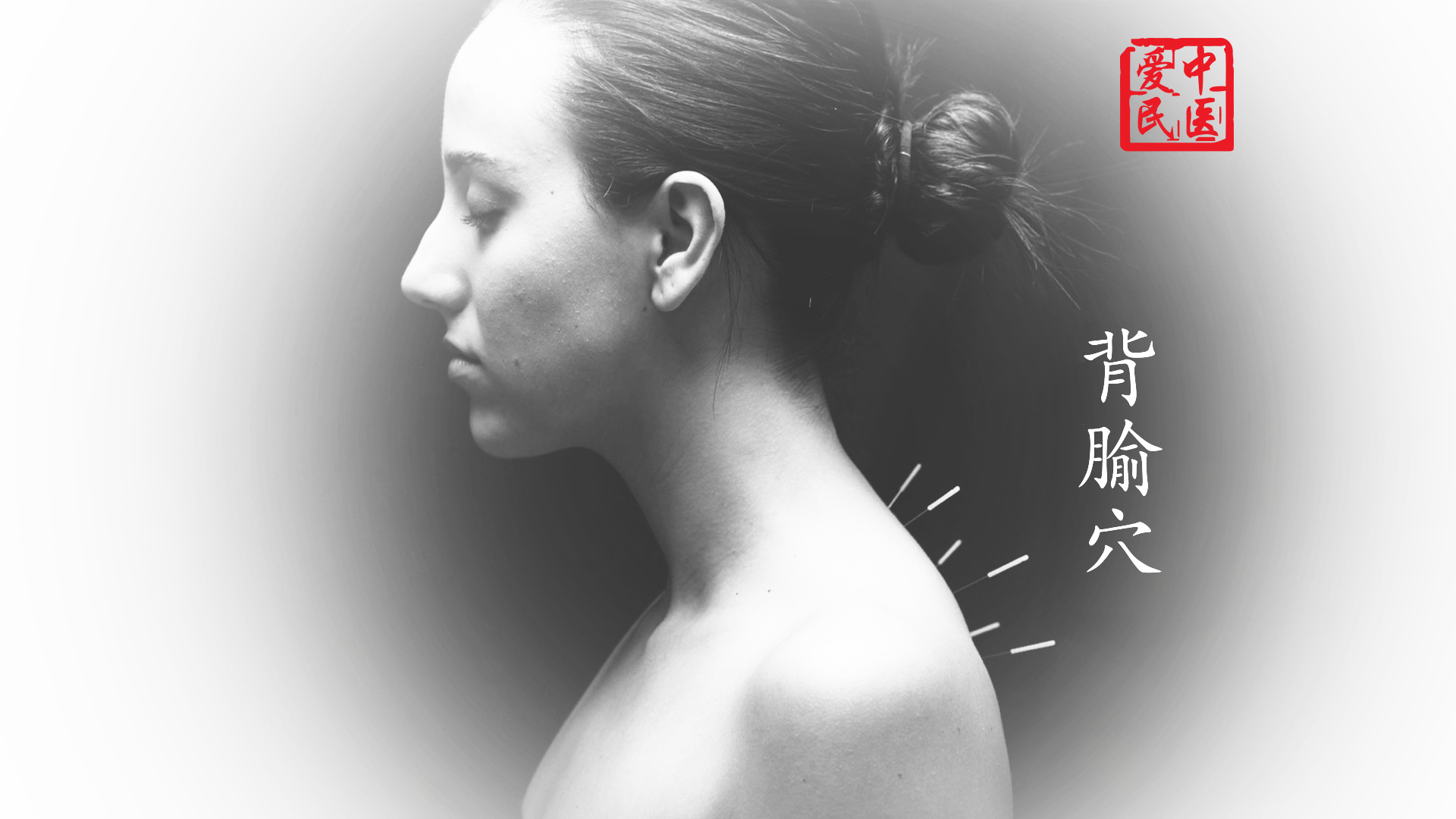 Acupuncture