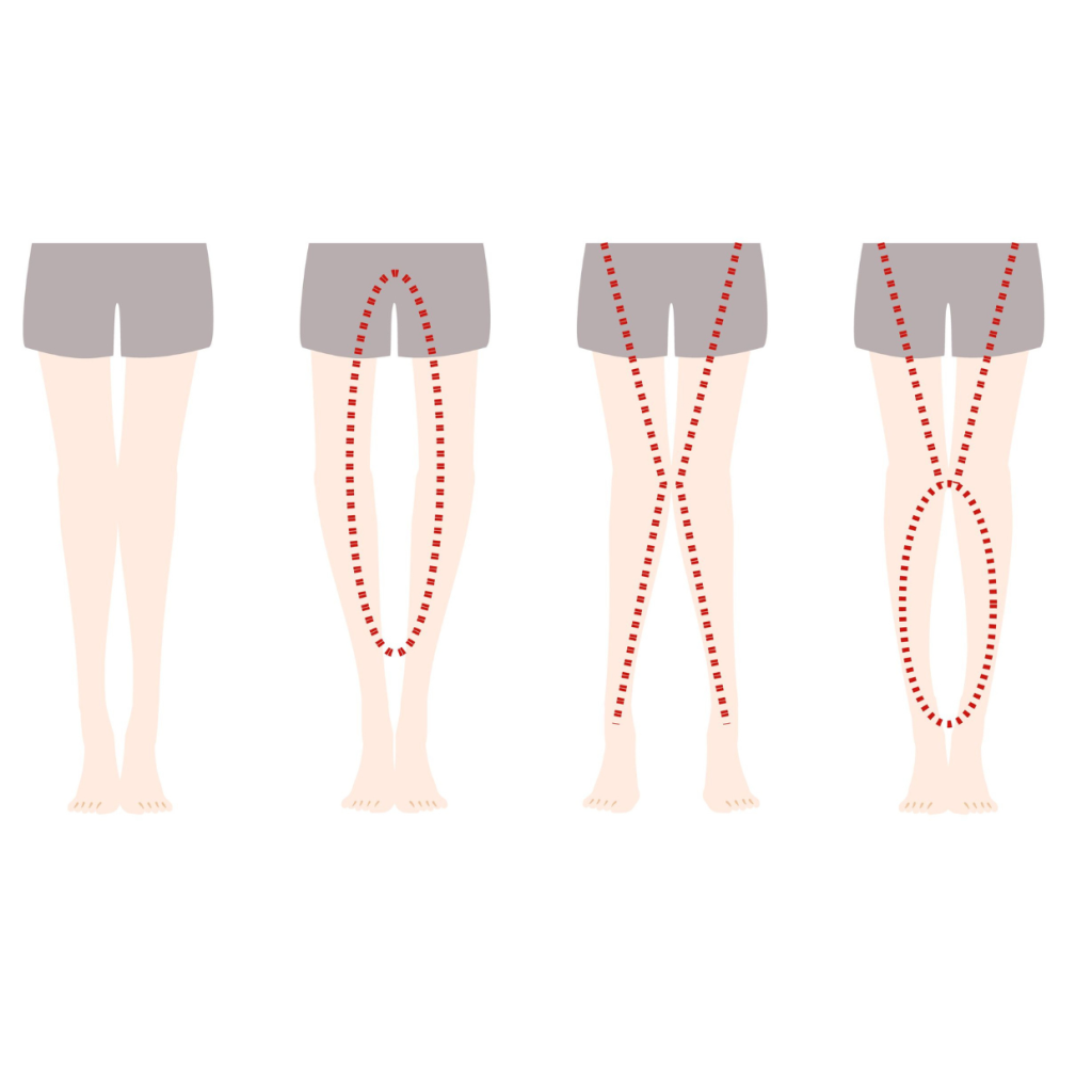 Deform Leg due to Pelvic Tilts