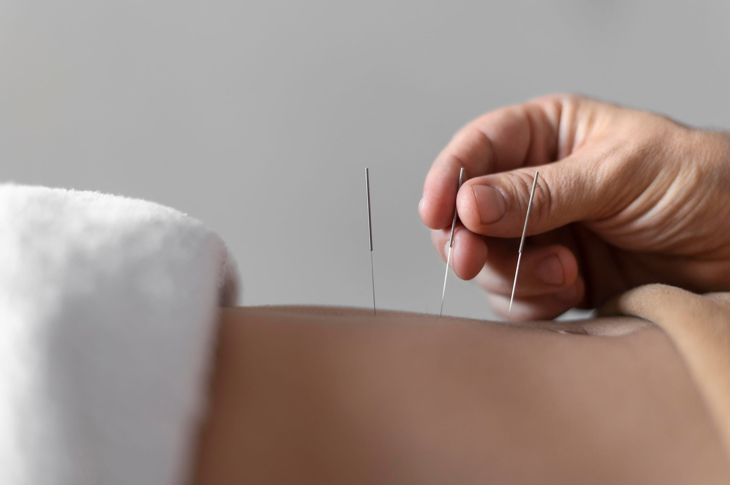 TCM slimming acupuncture treatment session