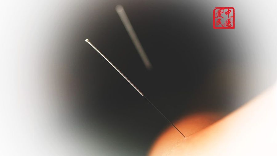 Shi-Style Weight Loss Acupuncture treatment session at Aimin TCM Clinic