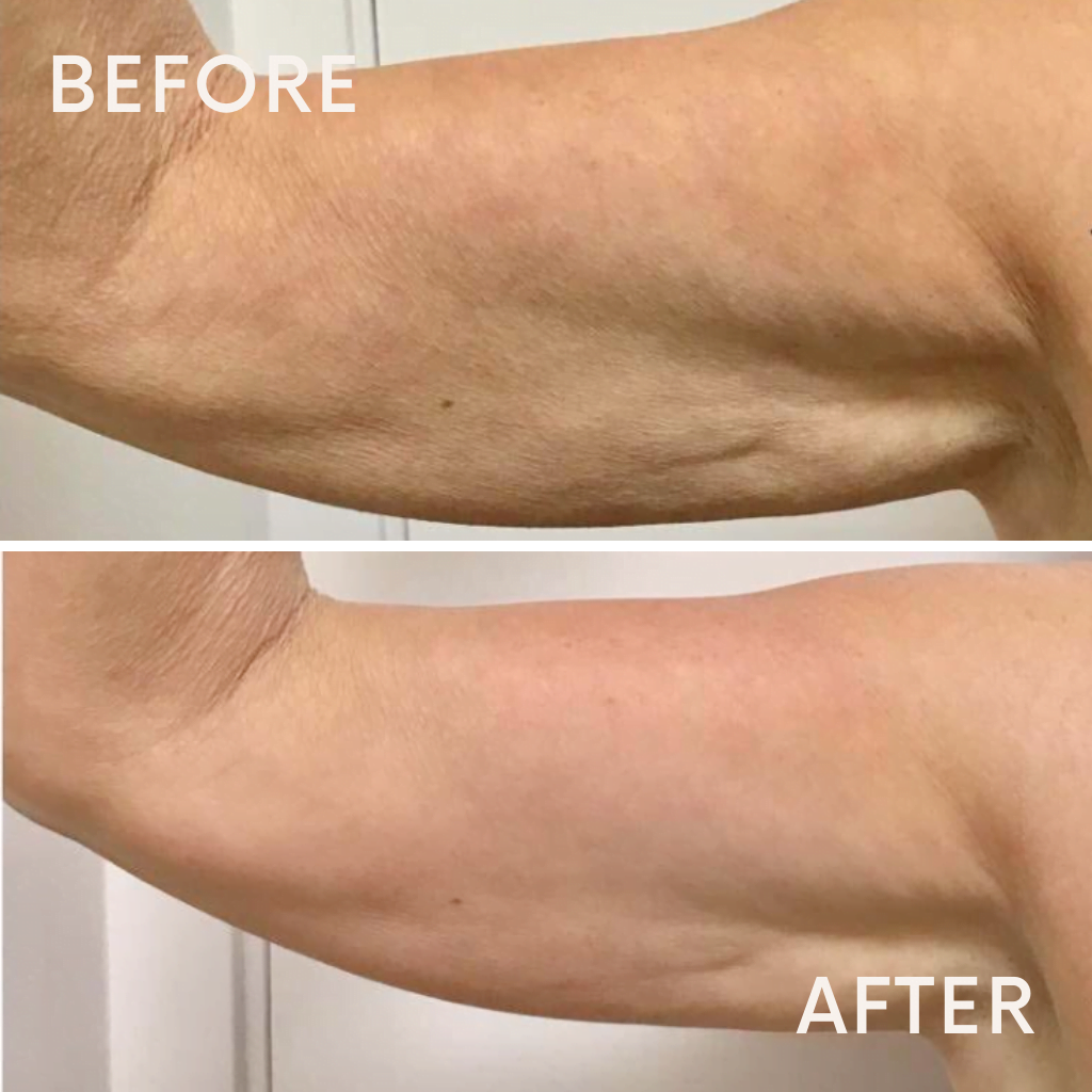 slimming treatment on my arm
