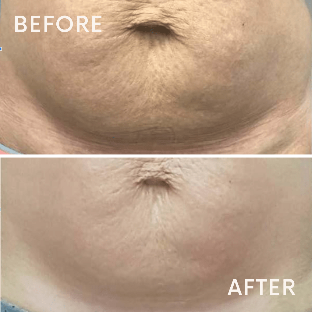 Belly fat loss treatment in aimin