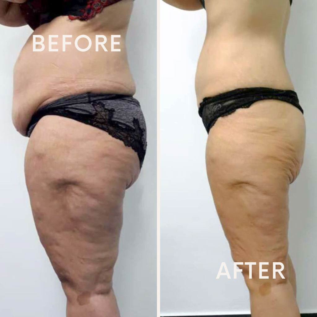 weight loss treatment result full body