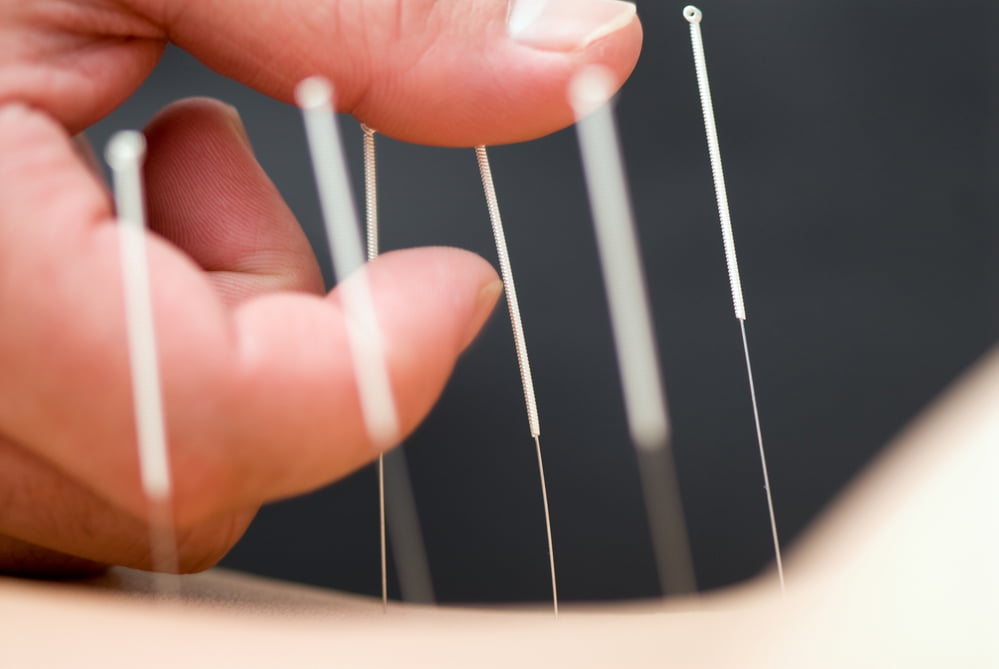 Professional TCM acupuncture treatment session at Aimin Clinic Singapore