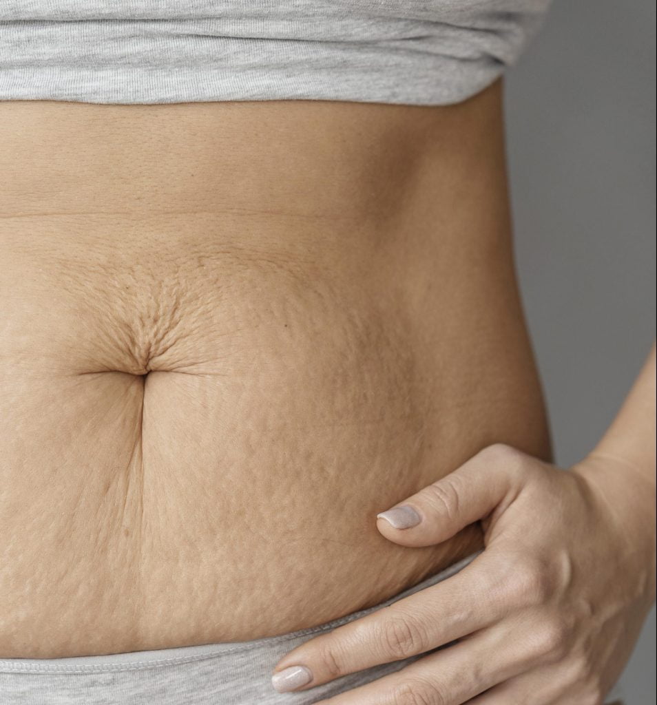 stretch mark removal