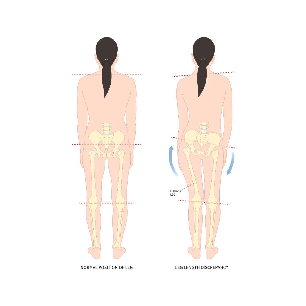 leg length due to pelvic tilt