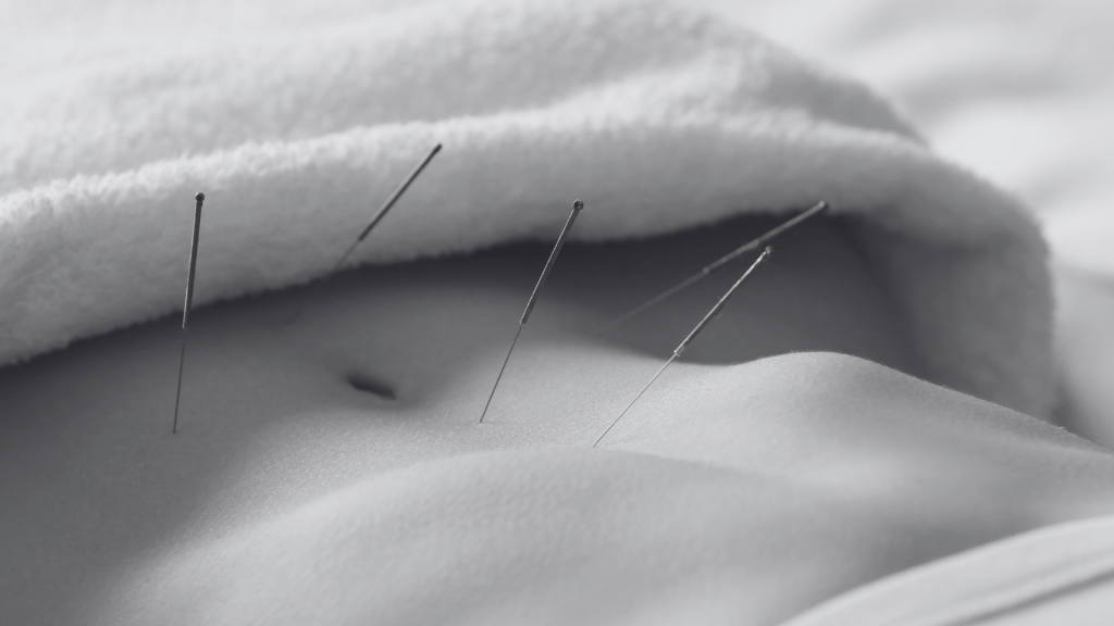 Shi-Style Weight Loss Acupuncture treatment at Aimin TCM Clinic