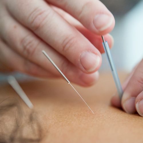 traditional-chinese-medicine-acupuncture-treatment-holistic